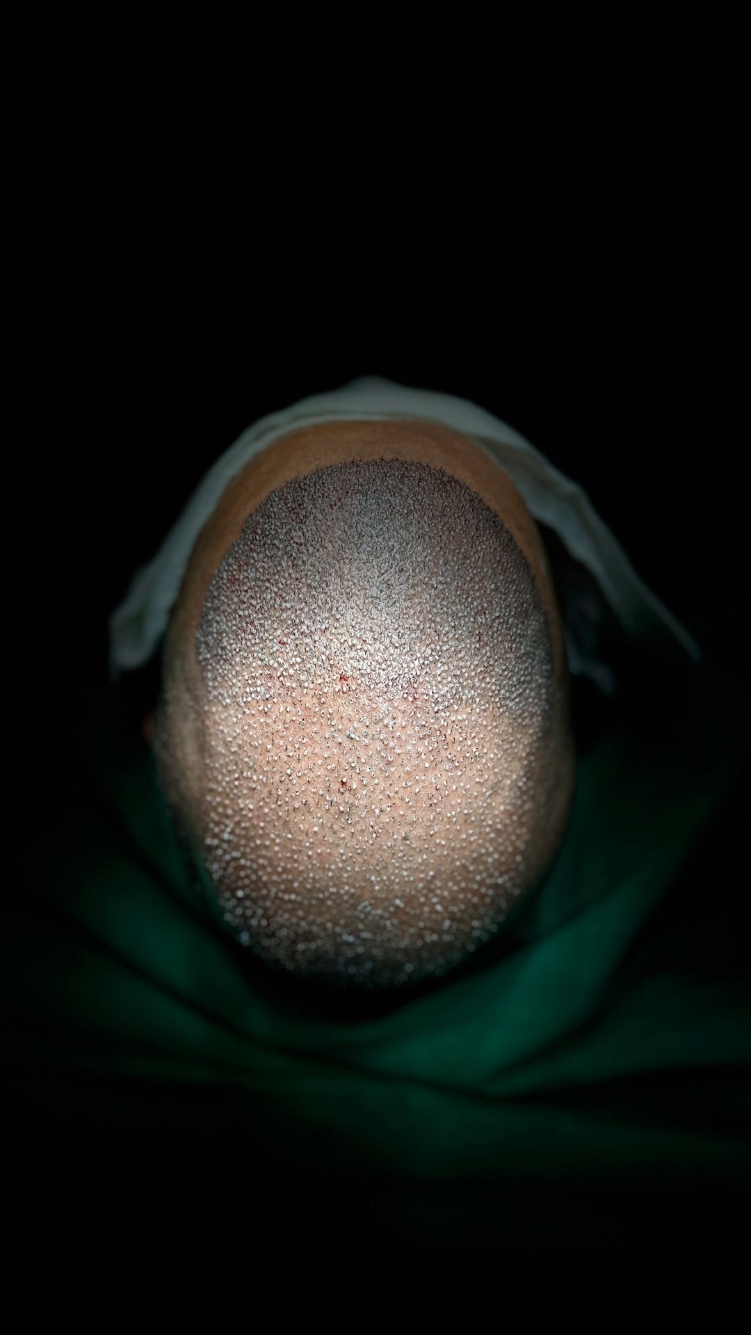 Transplante capilar FUE: couro cabeludo com folículos implantados