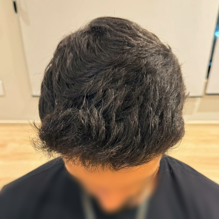Antes e depois de transplante capilar FUE nas entradas e topo da cabeça em Varginha MG, resultado após o tratamento