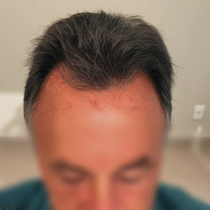 Antes e depois de transplante capilar FUE na linha frontal com Dr. Gustavo Valias, antes do tratamento