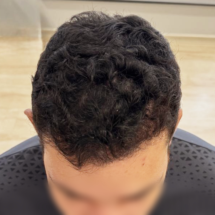 Antes e depois de transplante capilar FUE na coroa com Dr. Gustavo Valias, resultado após o tratamento
