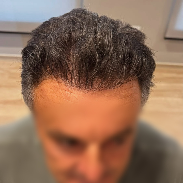 Antes e depois de transplante capilar FUE na linha frontal com Dr. Gustavo Valias, resultado após o tratamento