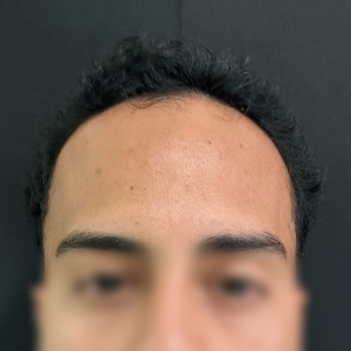 Antes e depois de aumento de densidade capilar na região frontal com Dr. Gustavo Valias, antes do tratamento