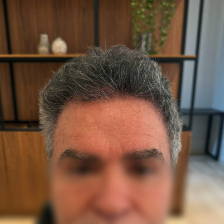 Antes e depois de reconstrução da linha frontal com transplante capilar FUE em Varginha MG, resultado após o tratamento