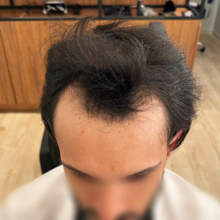 Antes e depois de transplante capilar FUE nas entradas e topo da cabeça em Varginha MG, antes do tratamento