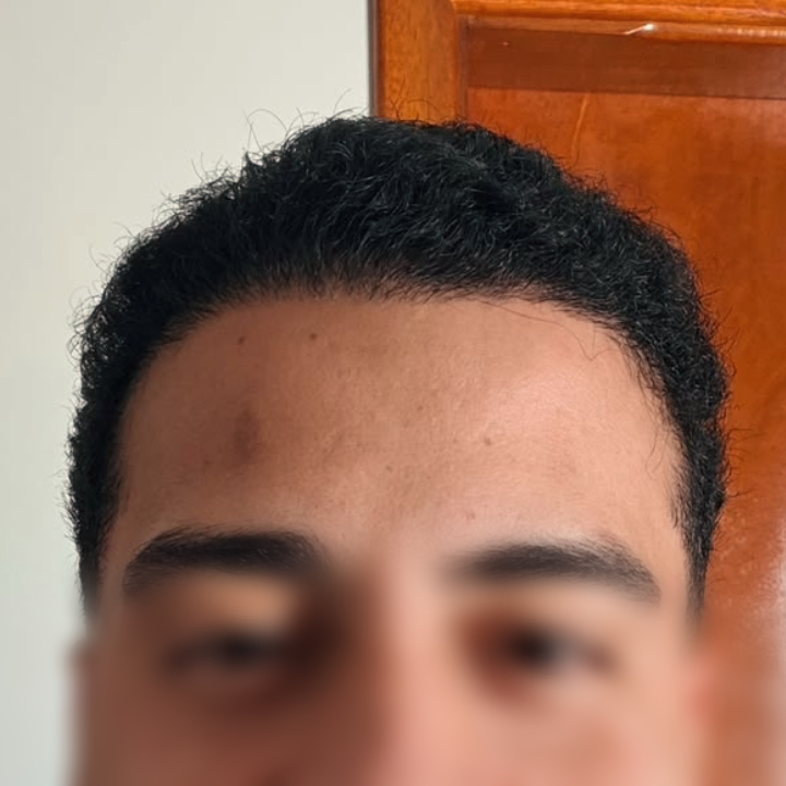 Antes e depois de aumento de densidade capilar na região frontal com Dr. Gustavo Valias, resultado após o tratamento