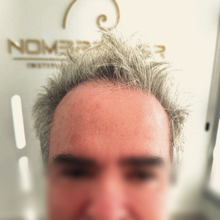 Antes e depois de reconstrução da linha frontal com transplante capilar FUE em Varginha MG, antes do tratamento