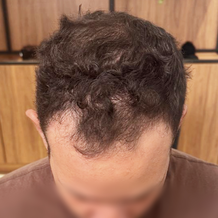 Antes e depois de transplante capilar FUE na coroa com Dr. Gustavo Valias, antes do tratamento